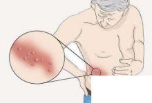 日常生活:纏腰龍到底是什么東西流傳腰上長(zhǎng)一圈就壽命已盡