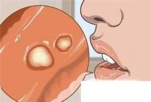 日常生活：治療口腔潰瘍的八種方法