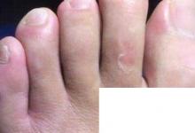 日常生活：水皰型足癬用什么藥腳上長了很多小水泡癢脫皮