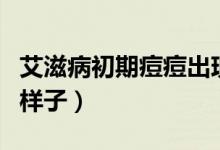 艾滋病初期痘痘出現(xiàn)位置（艾滋病初期痘痘的樣子）