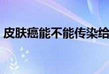 皮膚癌能不能傳染給別人（皮膚癌能活幾年）