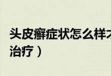 頭皮癬癥狀怎么樣才能治好（頭皮癬癥狀怎么治療）