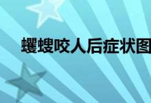 蠼螋咬人后癥狀圖片（蠼螋咬人后癥狀）