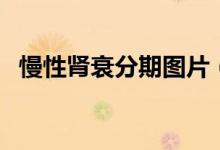 慢性腎衰分期圖片（慢性腎衰分期的標準）