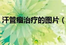 汗管瘤治療的圖片（汗管瘤的最佳治療方法）