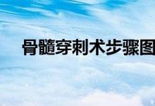 骨髓穿刺術(shù)步驟圖（骨髓穿刺術(shù)多少錢）