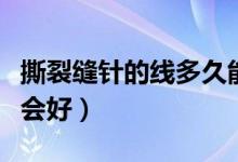 撕裂縫針的線多久能吸收（撕裂縫針的線多久會好）
