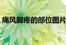 痛風腳疼的部位圖片（痛風常見部位是哪里）