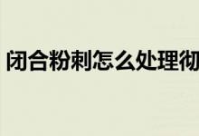 閉合粉刺怎么處理徹底（閉合粉刺怎么去除）