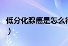 低分化腺癌是怎么得的（低分化腺癌是晚期嗎）