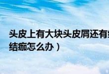 頭皮上有大塊頭皮屑還有結(jié)痂怎么處理（頭皮有大塊頭皮屑結(jié)痂怎么辦）