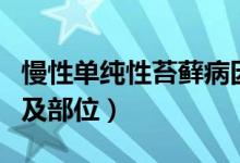 慢性單純性苔蘚病因（慢性單純性苔蘚的原因及部位）