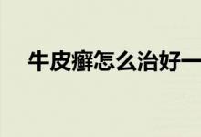 牛皮癬怎么治好一點（牛皮癬怎么治好）