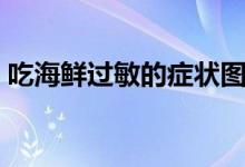 吃海鮮過敏的癥狀圖（吃海鮮過敏了怎么辦）