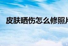 皮膚曬傷怎么修照片（皮膚曬傷怎么處理）